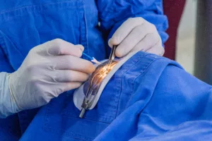 Catarata, Clínica Carriazo, Barranquilla, Colombia